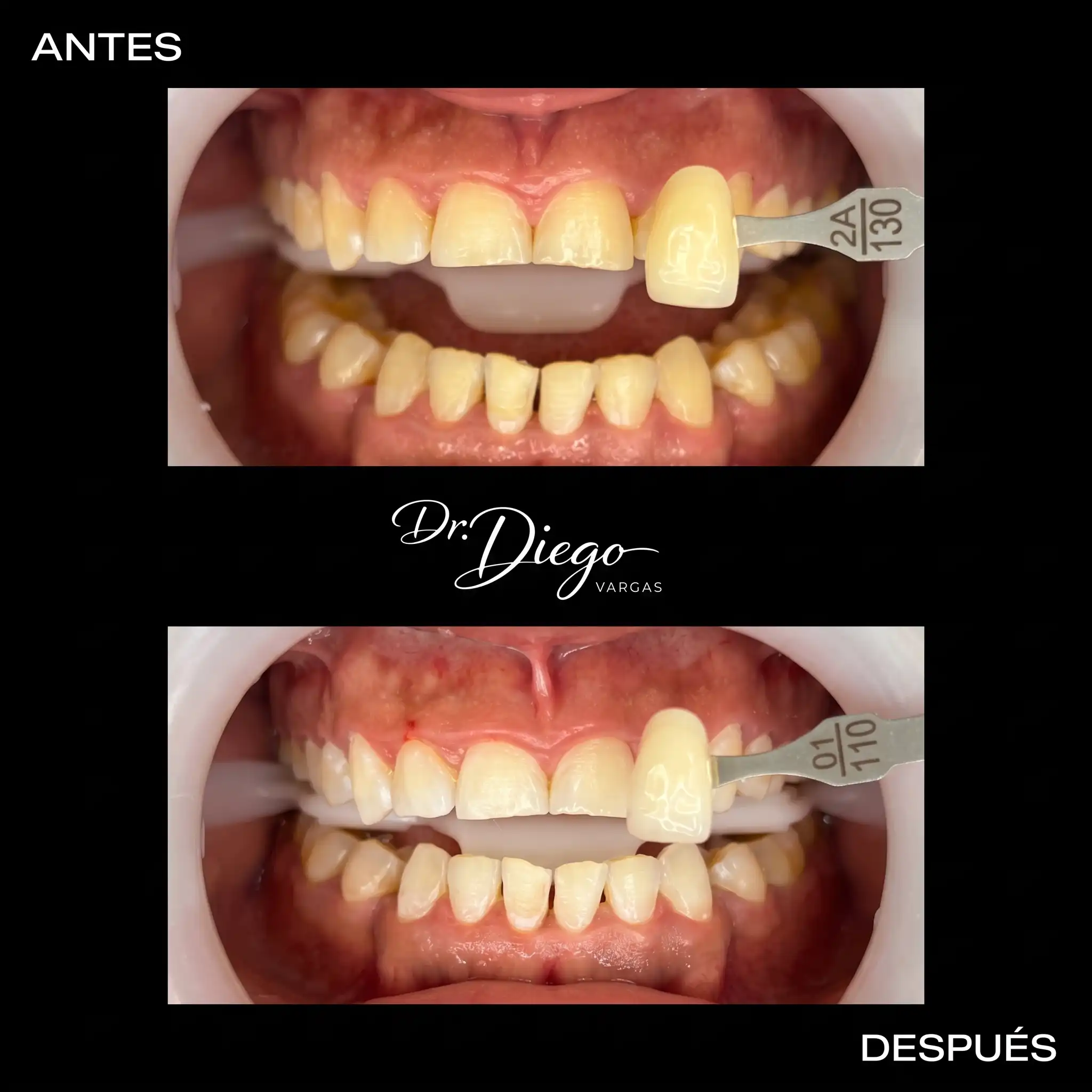 Antes y después carillas