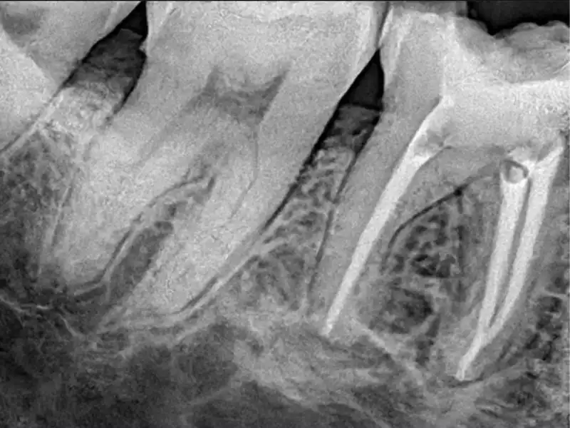 Radiografía Endodoncia 1
