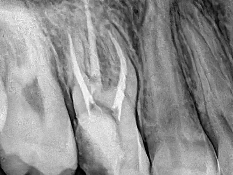 Radiografía Endodoncia 2